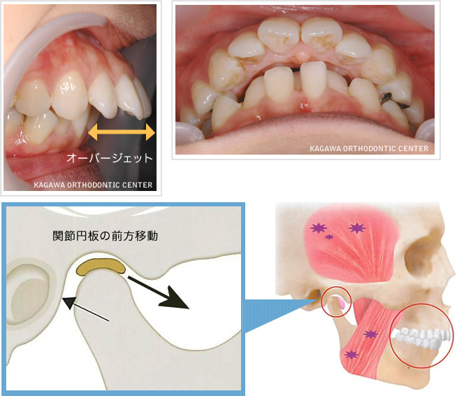 オーバージェット 関節円板の前方移動