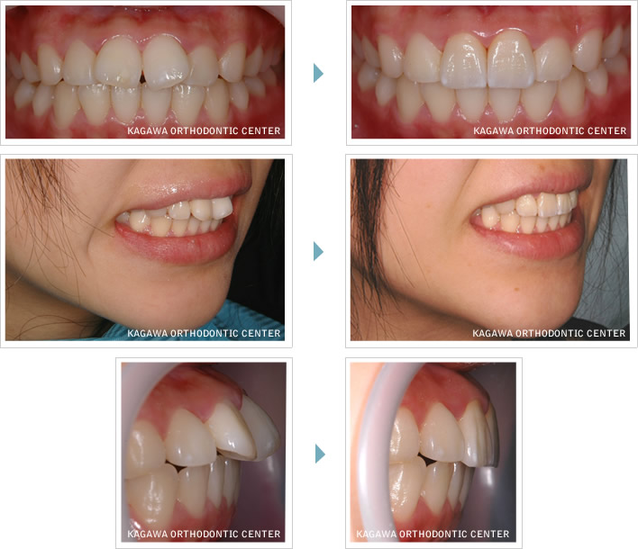 セラミック矯正治療 矯正 香川県 香川矯正センター たくま歯科は世界水準の治療