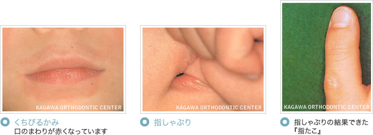 歯並びに影響する子供の癖（くせ）とMFT（口腔筋機能療法）イメージ