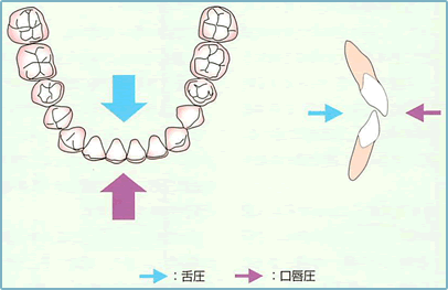 しゃぶり防止装置を使用してもらうイメージ２