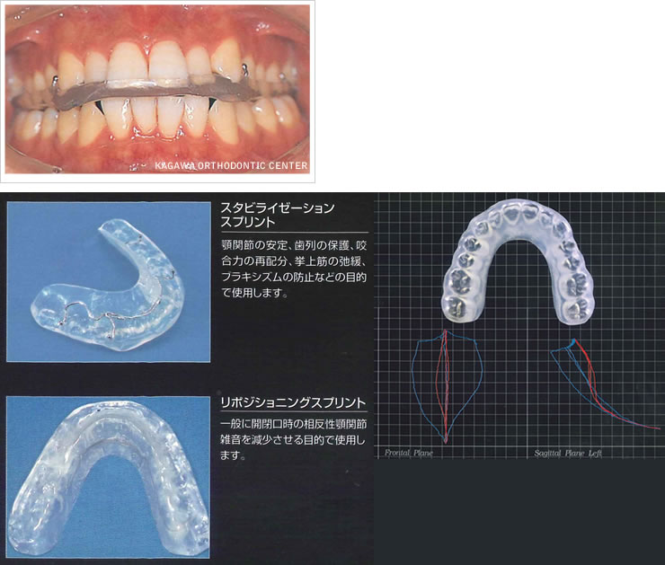 スプリント（顎関節保護装置）1