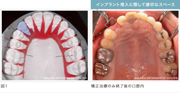 インプラント埋入に際して適切なスペース