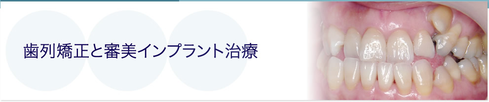 歯列矯正と審美インプラント治療