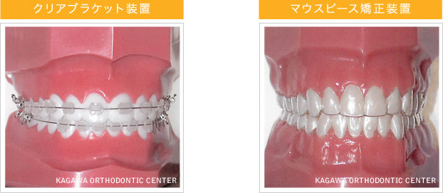 クリアブラケット装置・マウスピース矯正装置