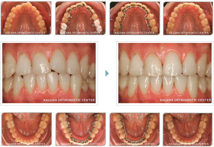 リンガル（舌側・裏側）矯正装置使用による口腔内変化イメージ