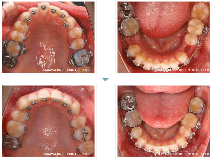ハーフリンガル（舌側・裏側）矯正の口腔内変化イメージ