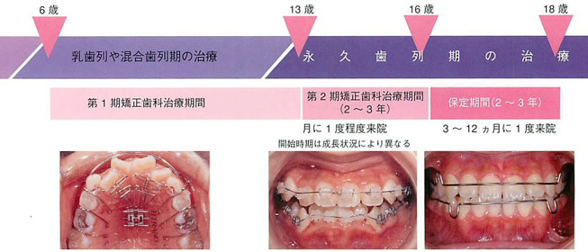 子供の早期矯正治療についてですが、何歳ぐらいで相談したらよいのでしょうか？イメージ