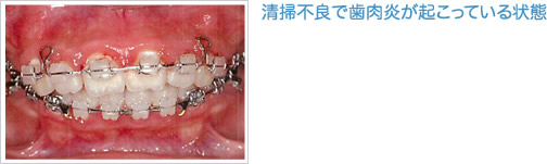 清掃不良で歯肉炎が起こっている状態