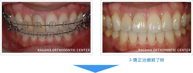 矯正治療終了時