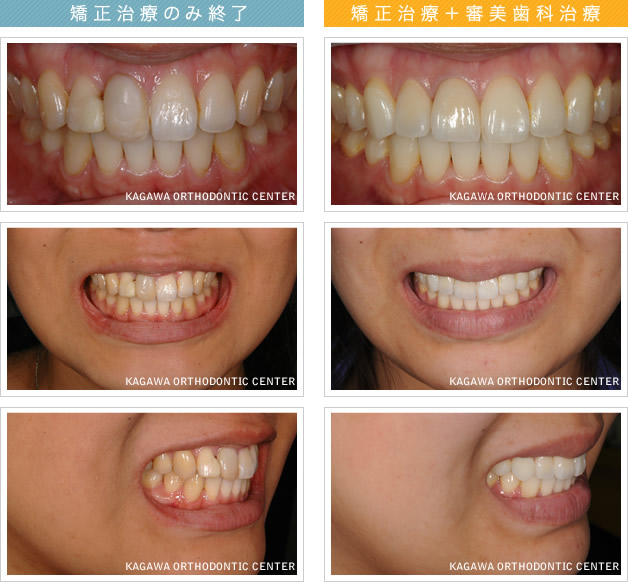 矯正治療のみ終了 矯正治療＋審美歯科治療