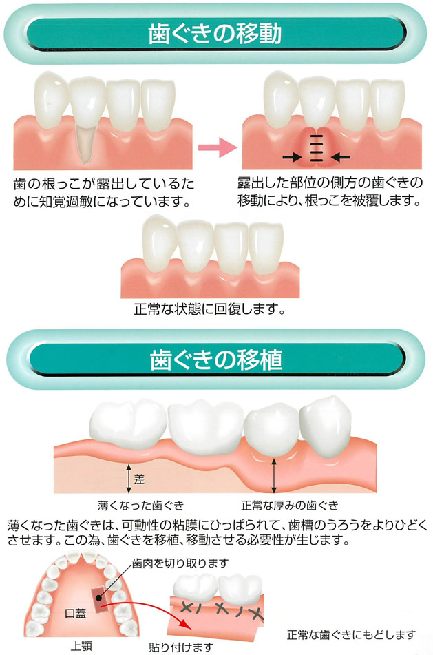 歯ぐきの移動