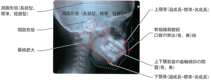 主として側貌セファロレントゲン（矯正専用）で確認している事項イメージ