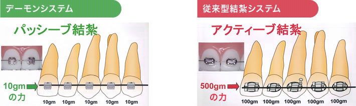 デーモンシステム 従来型結紮システム