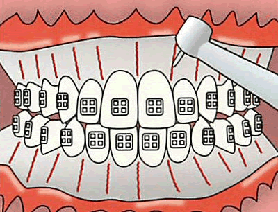 3) 促進矯正法（スピード矯正）イメージ