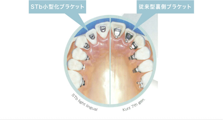 STb小型化ブラケット 従来型裏側ブラケット