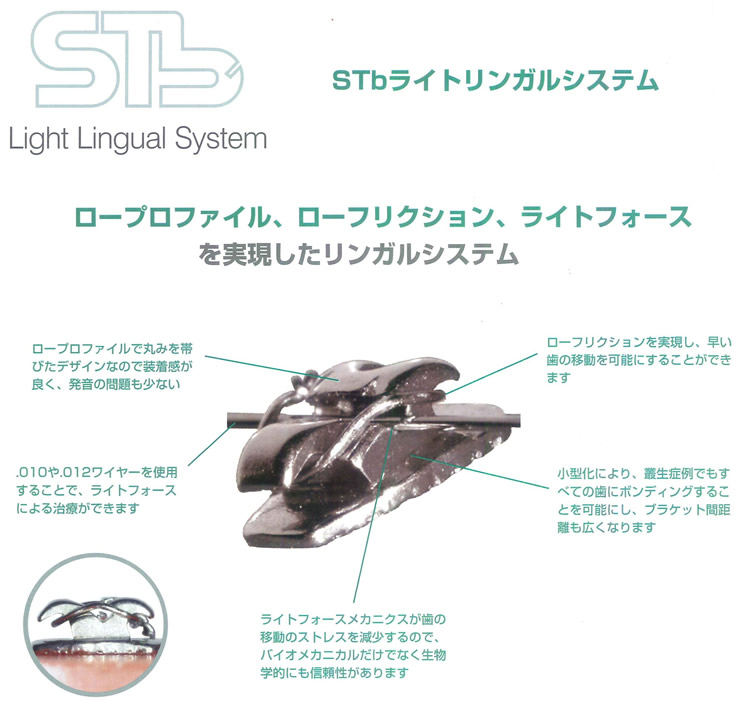 STbリンガルブラケットシステム