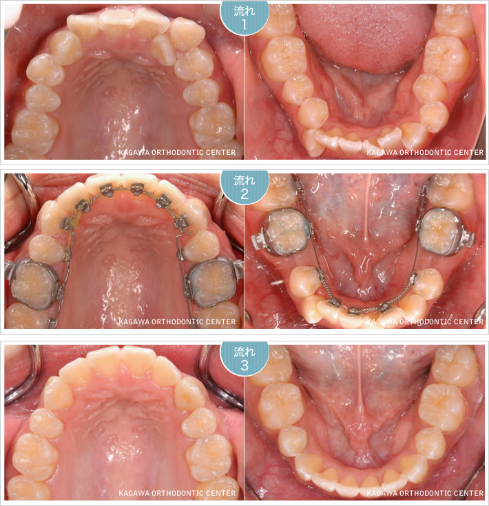 矯正治療の流れイメージ