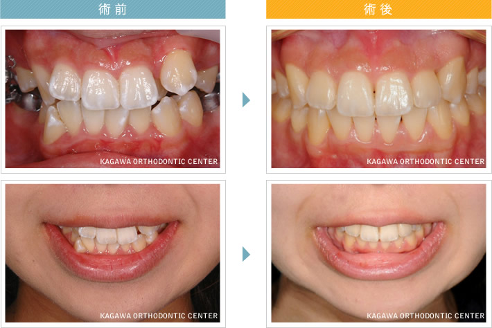 矯正 香川県 香川矯正センター たくま歯科は世界水準の治療