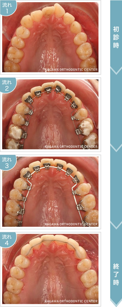 ハーモニーリンガルCAD/CAMシステムによる矯正治療の流れ イメージ