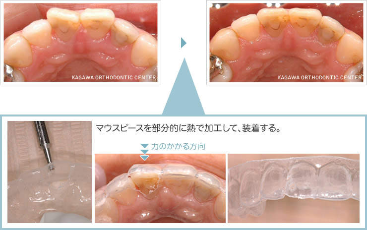 マウスピースを部分的に熱で加工して、装着する。