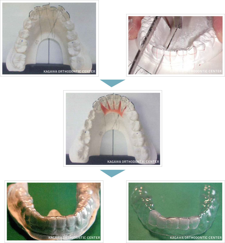 一般的なマウスピース矯正装置の製造工程（タイプＢ）イメージ