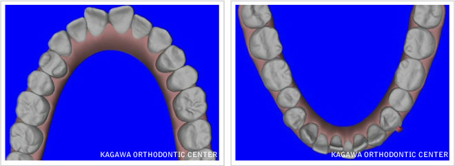 歯型をスキャンニングしてコンピュータに取り込んだ状態（CAD）イメージ