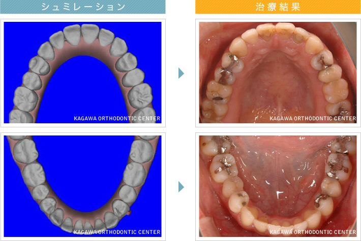 シュミレーション 治療結果