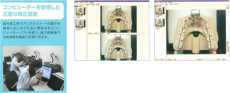 アソアライナー作製時の歯の移動量決定の方法（二次元的な写真重ね合わせ法）イメージ
