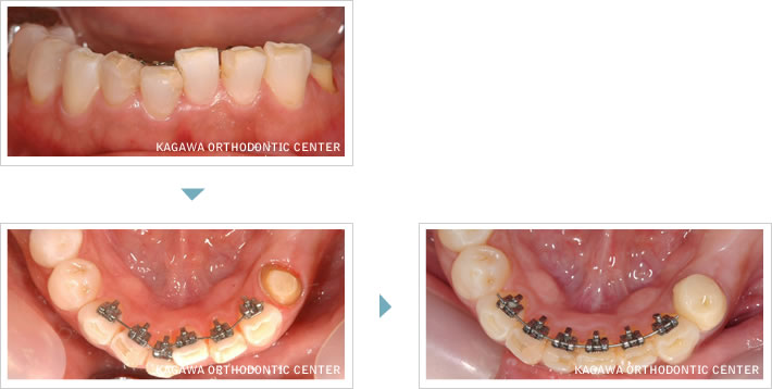 下顎前歯の歯列矯正治療（部分リンガル舌側矯正）例1