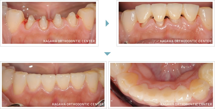 下顎前歯の審美修復治療 (オールセラミッククラウン) 例1