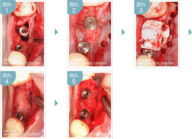 左下臼歯部インプラント治療 例1