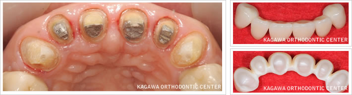 上顎前歯の審美修復治療 (オールセラミッククラウン) 例1