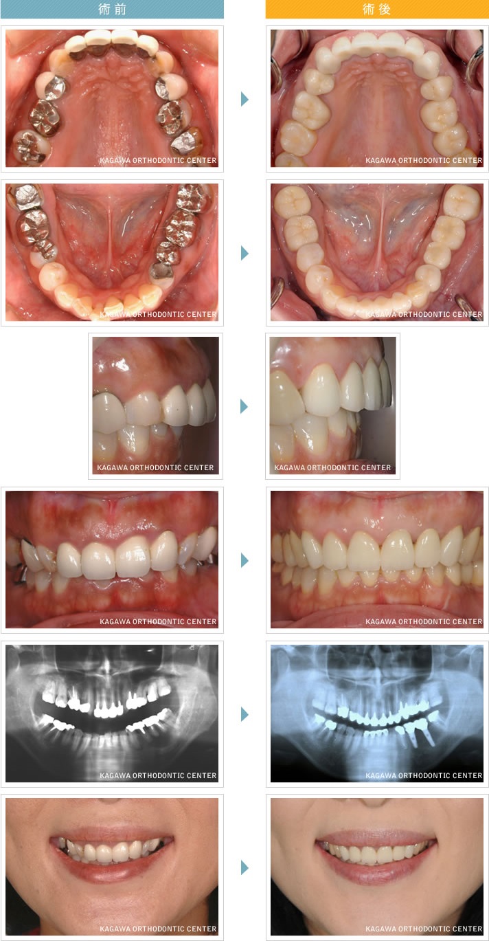 before ＆ after1