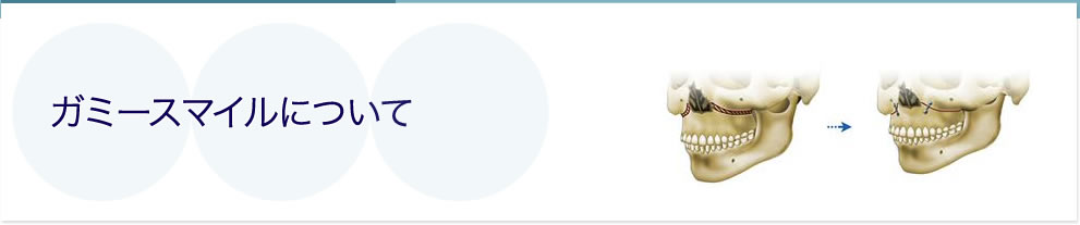 ガミースマイルについて