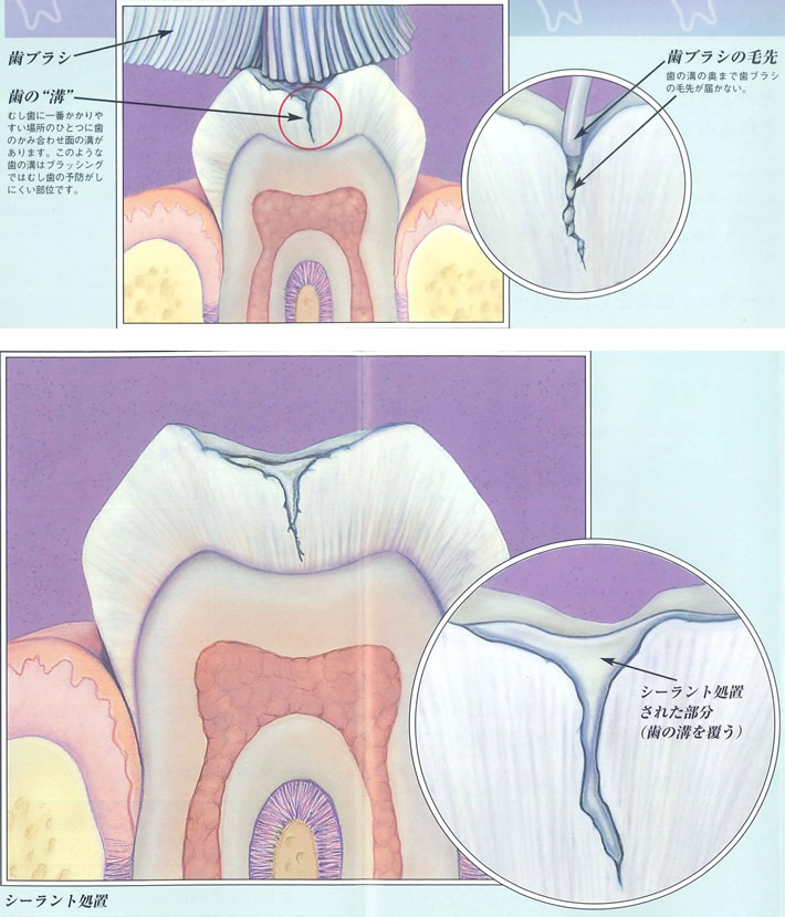 シーラント処置