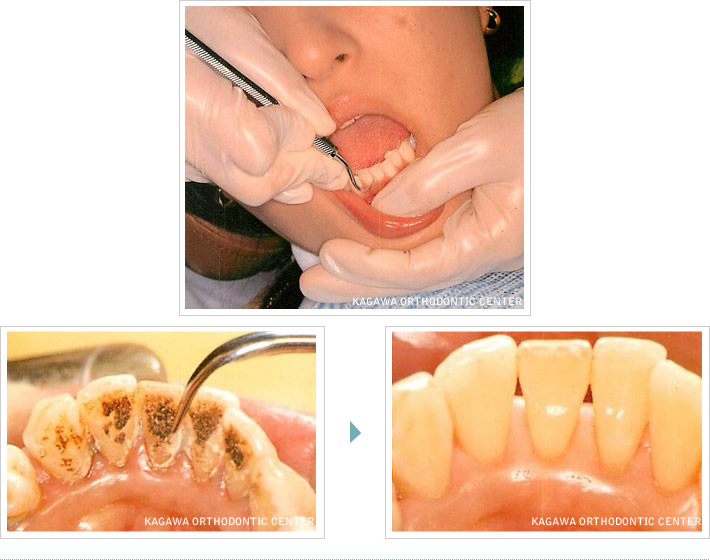 歯石除去イメージ