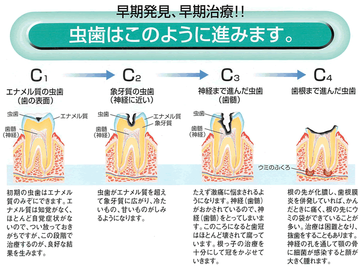 虫歯はこのように進みます