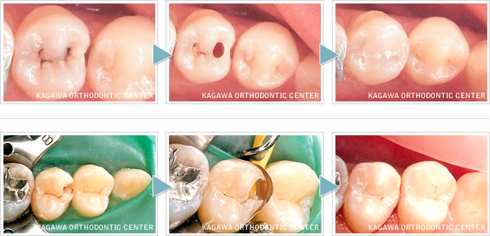 虫歯治療イメージ3