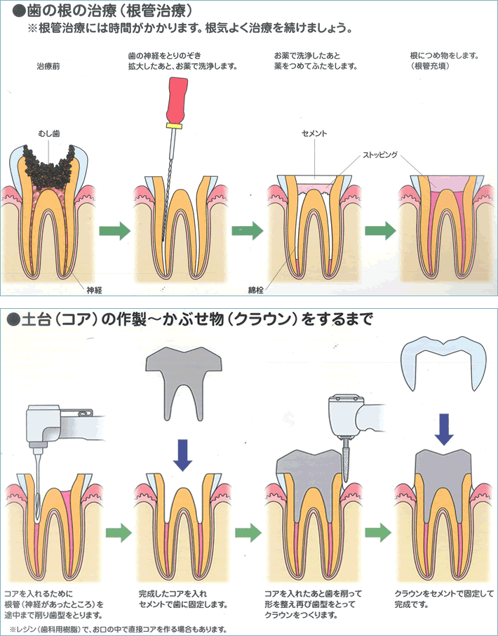 根管治療