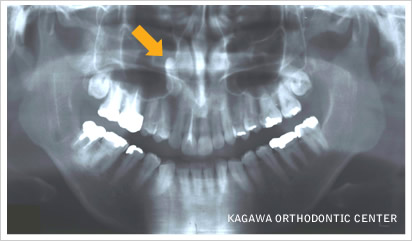 レントゲン写真