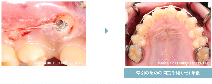 牽引のための開窓手術から1年後