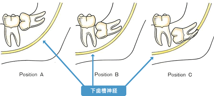 親知らずと下歯槽神経の位置関係イメージ