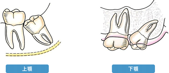 簡単に抜歯可能で、術後腫脹が小さい場合　（粘膜から頭が露出している）イメージ