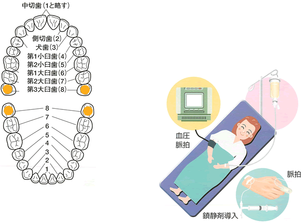 親知らずが粘膜下に隠れている場合の抜歯手順　（a→c）イメージ2