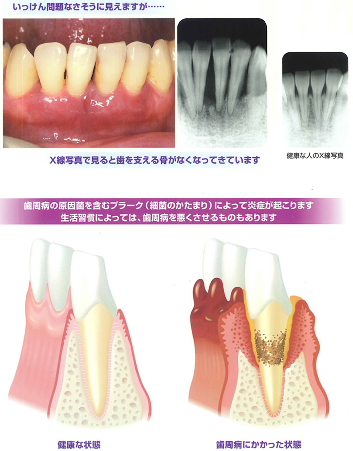 歯周病って、なに？