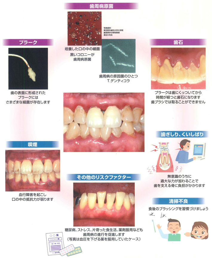 なぜ、歯周病になるの？イメージ