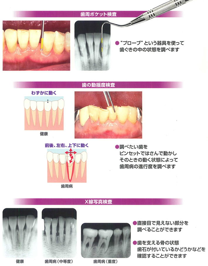 歯周病かどうかを調べるには？イメージ