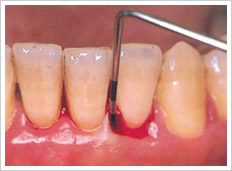 歯周ポケット検査で出血が認められるイメージ