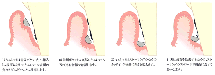 スケーリング・ルートプレーニング（ＳＲＰ）中に歯周ポケット内で行われていること