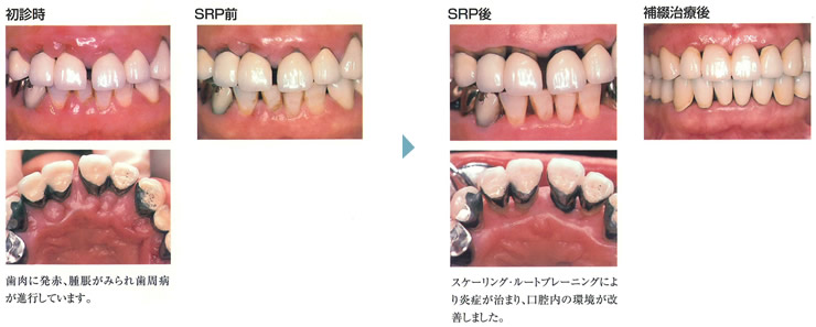 スケーリング・ルートプレーニング（ＳＲＰ）による歯周組織の炎症改善イメージ